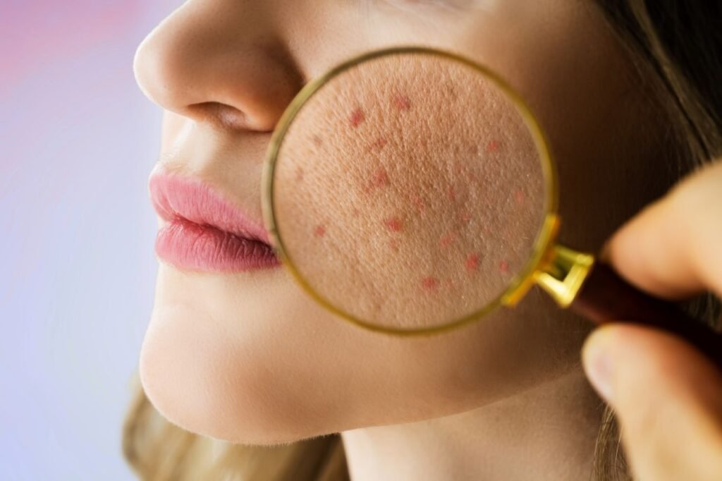 Close-up of a young adult woman with visible acne on her face, highlighting common areas affected by adult acne.